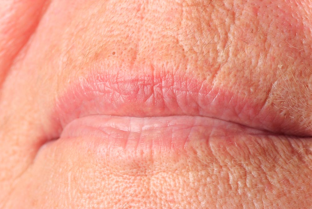 Botox® treatment Smokers Lines Haywards Heath